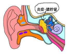 耳かき し 過ぎ